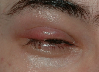 Arpacık Neden Çıkar? Arpacık Neden Çıkar?