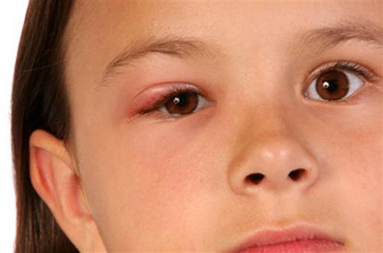 Arpacık Kisti Belirtileri ve Tedavisi